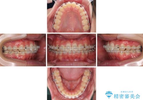 深い咬み合わせとデコボコ ワイヤー矯正で短期治療の治療中
