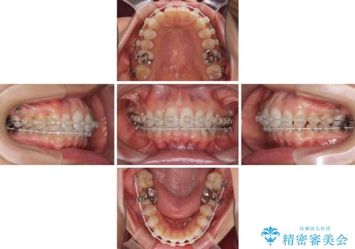 深い咬み合わせと奥歯のむし歯 総合歯科治療の治療中
