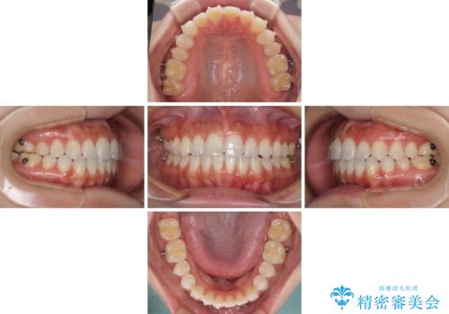 前歯のオープンバイトを治したい インビザラインでの矯正治療の治療中