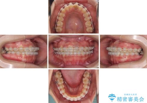前歯のクロスバイトと変色した歯 ワイヤー矯正とセラミック治療の治療中