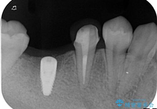 保存不可能な歯を抜歯してインプラント治療の治療中