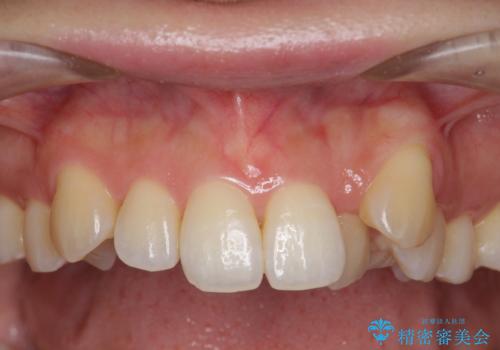[ 八重歯 ] マウスピース部分矯正による改善の症例 治療前