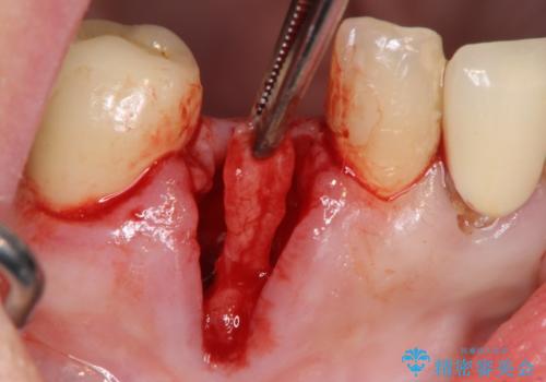 吸収した骨の再生　前歯部インプラント治療の治療中