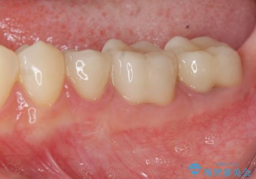 深い虫歯　歯周外科を併用した精度の高い補綴治療の症例 治療後