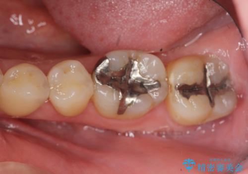 見える銀歯を白くの治療前