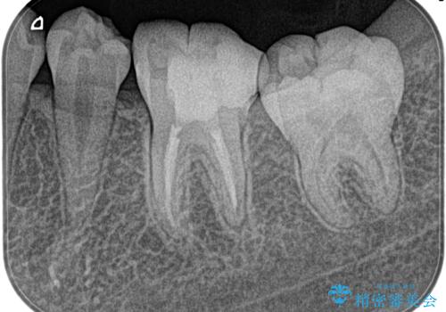 昨晩から激痛。精密根管治療の治療後