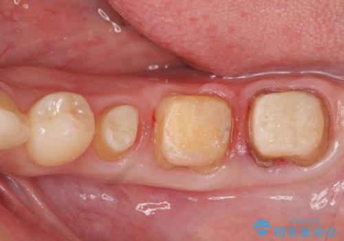 深い虫歯 歯周外科を併用した精度の高い補綴治療の治療中