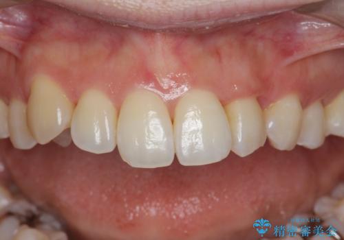 [ 八重歯 ] マウスピース部分矯正による改善の症例 治療後