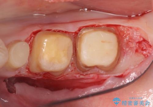 深い虫歯 歯周外科を併用した精度の高い補綴治療の治療中