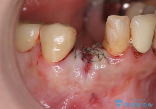 吸収した骨の再生 前歯部インプラント治療の治療中