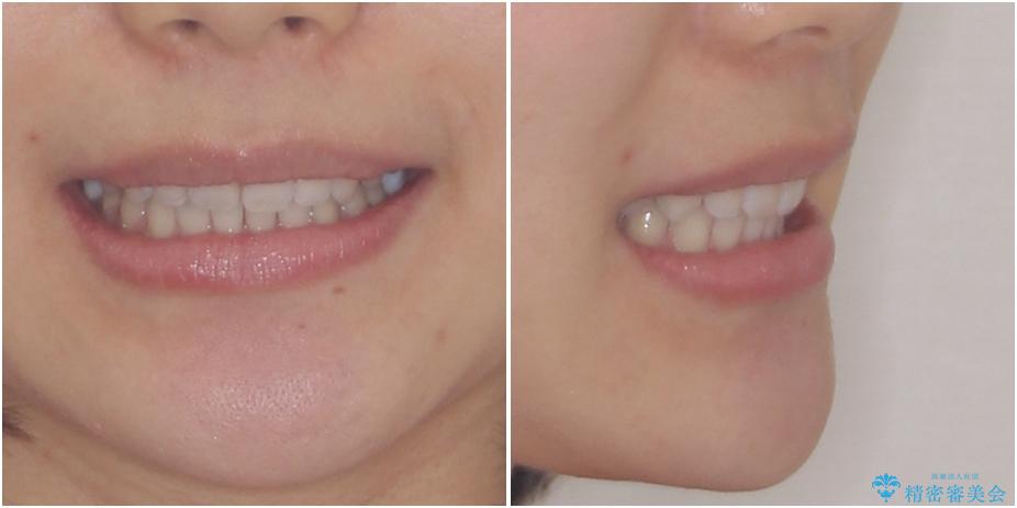深い咬み合わせと奥歯のむし歯　総合歯科治療の治療後（顔貌）