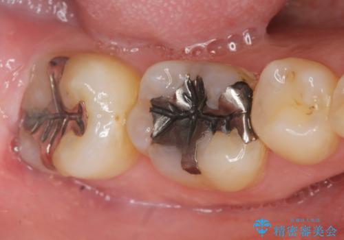 笑った時に見える銀歯を白くしたいの治療前