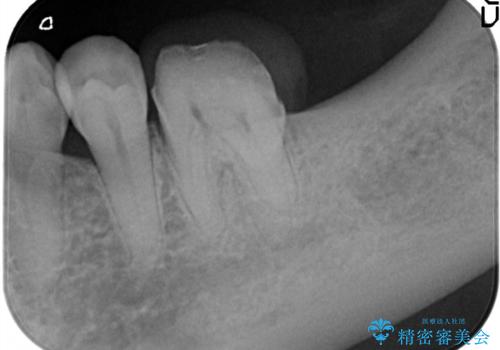 失った歯のインプラントでの咬合回復の治療前