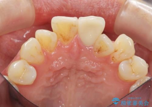 歯の変色 前歯の審美改善の治療後