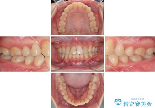 継ぎ接ぎだらけの前歯を綺麗にしたい 前歯のオールセラミックの治療前