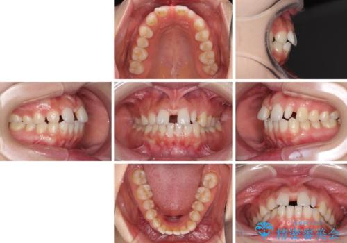 欠損歯と矮小歯 矯正治療と前歯のセラミック治療の治療前