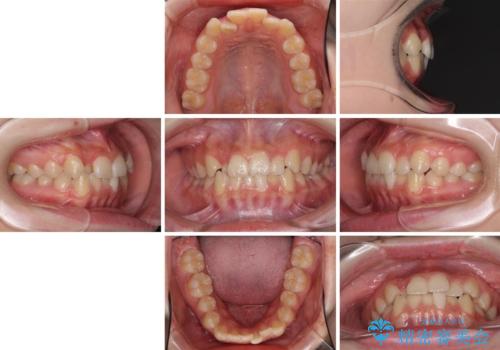 前歯のクロスバイト メタル装置での矯正治療の治療前