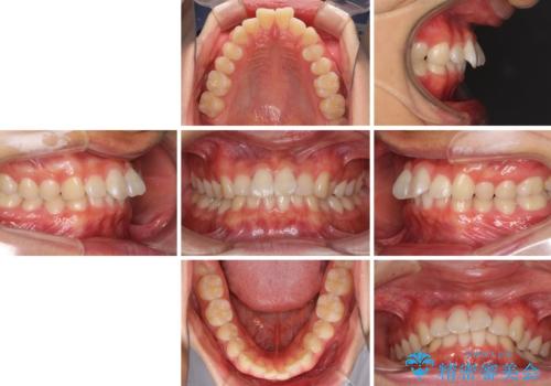 深い咬み合わせとデコボコ ワイヤー矯正で短期治療の治療前