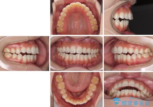 前歯のオープンバイトを治したい インビザラインでの矯正治療の治療前