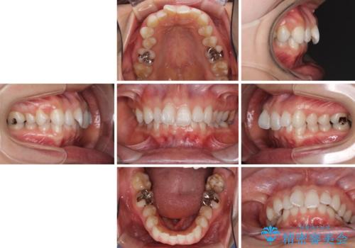 深い咬み合わせと奥歯のむし歯 総合歯科治療の治療前