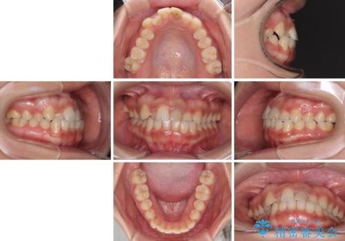 前歯のクロスバイトと変色した歯 ワイヤー矯正とセラミック治療の治療前