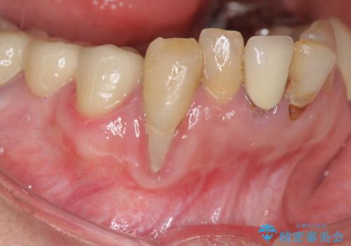 吸収した骨の再生　前歯部インプラント治療の治療前
