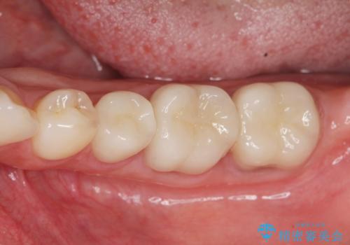 深い虫歯　歯周外科を併用した精度の高い補綴治療の治療後