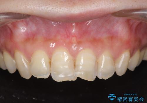 [[セラミック治療]]  溶けて形の悪くなった歯を改善したいの治療前