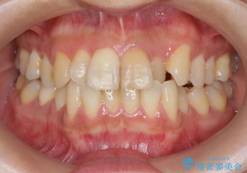 歯の変色　前歯の審美改善の治療前