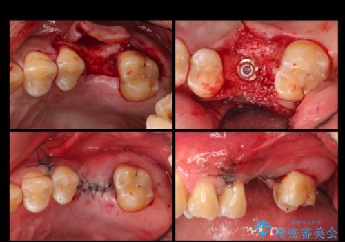 上の奥歯のインプラント、全体的な虫歯治療の治療中