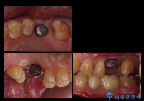 上の奥歯のインプラント、全体的な虫歯治療の治療中