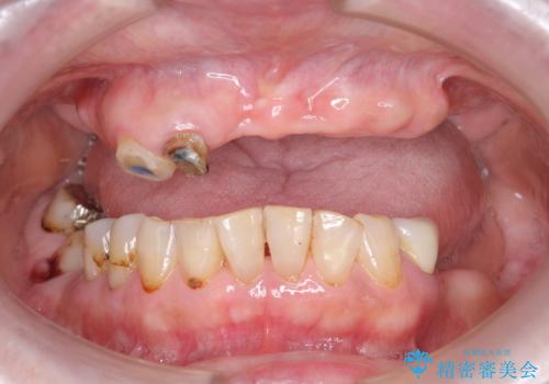 [[ 上顎多数歯欠損 ]]   インプラント・義歯を用いた補綴の治療前
