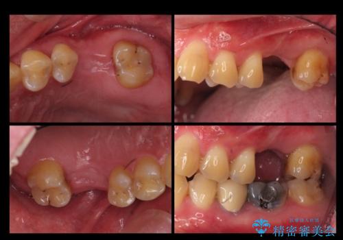 上の奥歯のインプラント、全体的な虫歯治療の治療前