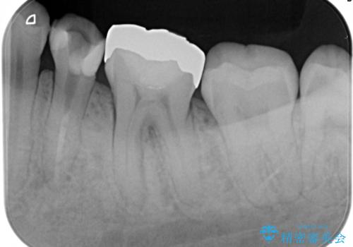 精密根管治療。大臼歯イニシャルケースの治療前