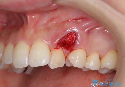 [ 八重歯 ] マウスピース部分矯正による改善の治療中