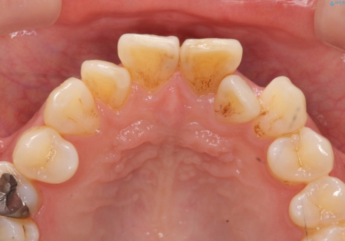 歯の変色 前歯の審美改善の治療前