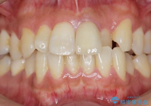 歯の変色 前歯の審美改善の治療後
