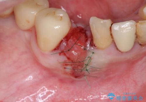 吸収した骨の再生 前歯部インプラント治療の治療中
