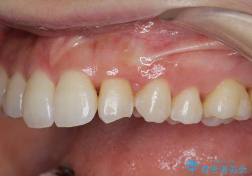 [ 八重歯 ] マウスピース部分矯正による改善の治療後