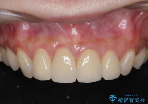 [[セラミック治療]]  溶けて形の悪くなった歯を改善したいの治療後