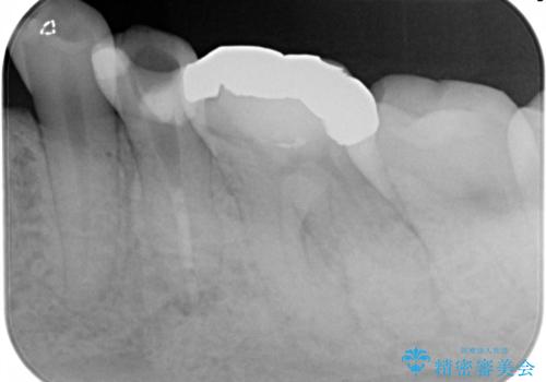 精密根管治療。大臼歯イニシャルケースの治療前