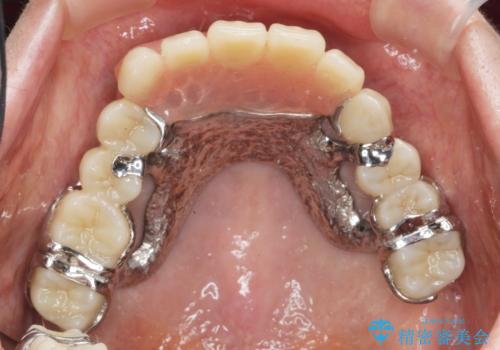 [[ 上顎多数歯欠損 ]]   インプラント・義歯を用いた補綴の治療後