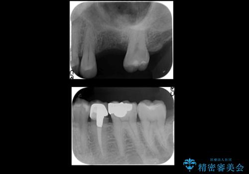 上の奥歯のインプラント、全体的な虫歯治療の治療前