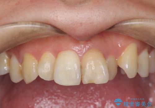 歯の変色　前歯の審美改善の治療前