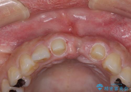 前歯のブリッジが気に入らない　歯肉移植術を併用した前歯のブリッジの治療中