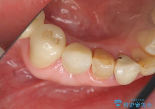 吸収した骨の再生 前歯部インプラント治療の治療後