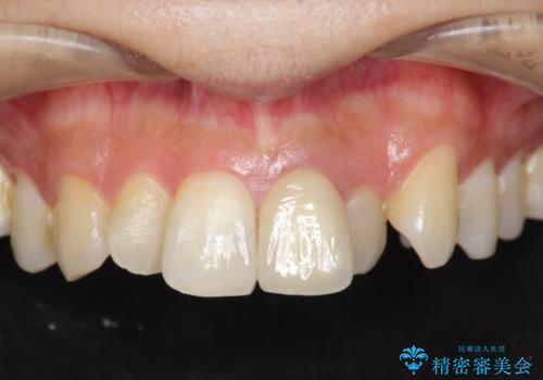歯の変色　前歯の審美改善