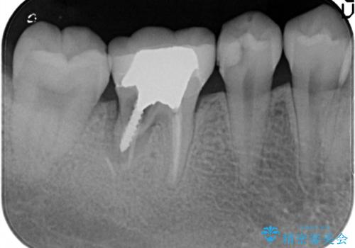 保存不可能な歯を抜歯してインプラント治療の治療前