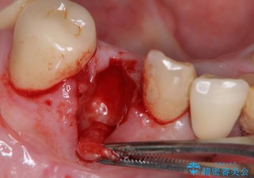 吸収した骨の再生 前歯部インプラント治療の治療中