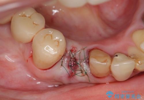吸収した骨の再生 前歯部インプラント治療の治療中
